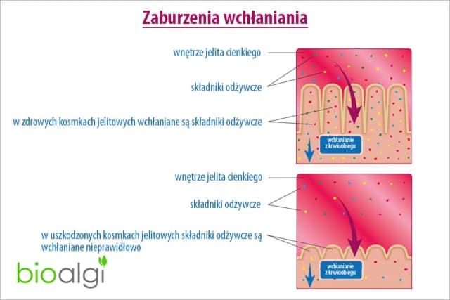 Objawy zaburzeń wchłaniania – jak rozpoznać i co może je powodować? Objawy zaburzeń wchłaniania – jak rozpoznać i co może je powodować?