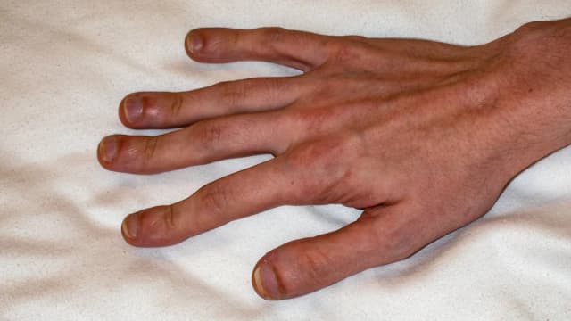 Krzywe palce u rąk: Zdjęcia, przyczyny i skutki deformacji Krzywe palce u rąk: Zdjęcia, przyczyny i skutki deformacji