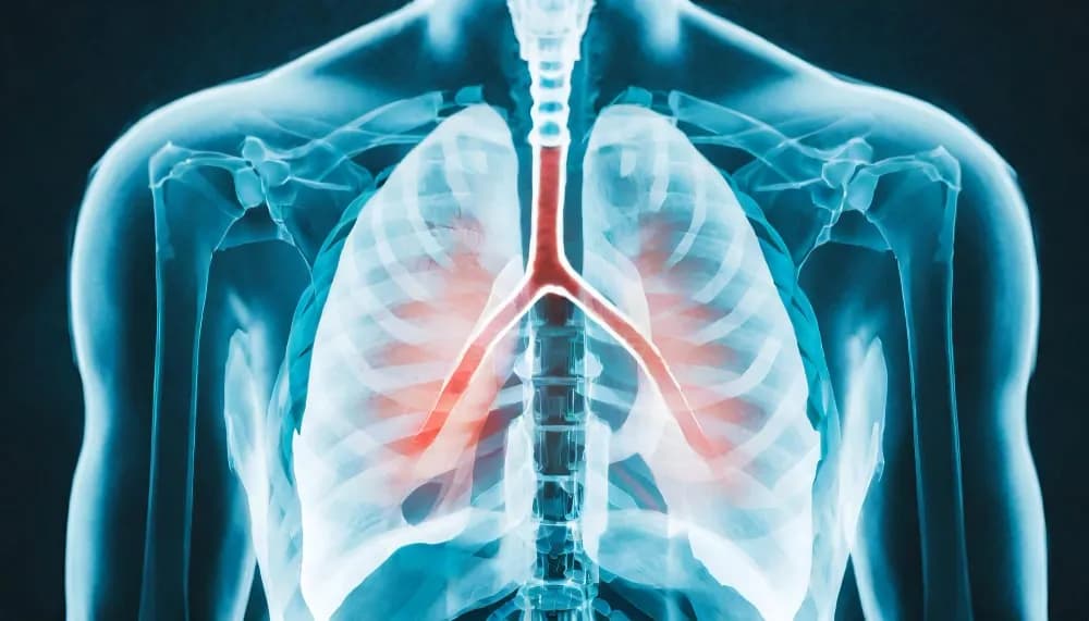 Skuteczne leki na zapalenie płuc: bezpieczne metody leczenia i kuracji Skuteczne leki na zapalenie płuc: bezpieczne metody leczenia i kuracji