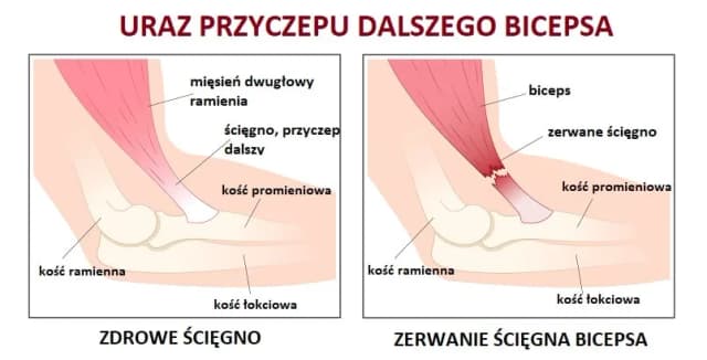 Naderwany biceps: 5 kluczowych objawów, które musisz znać Naderwany biceps: 5 kluczowych objawów, które musisz znać
