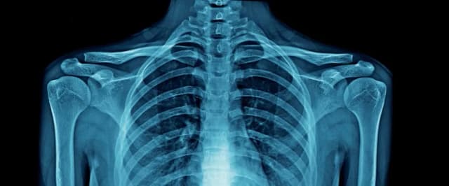 Skuteczne leczenie nadżerek kości: kompleksowa terapia i metody Skuteczne leczenie nadżerek kości: kompleksowa terapia i metody