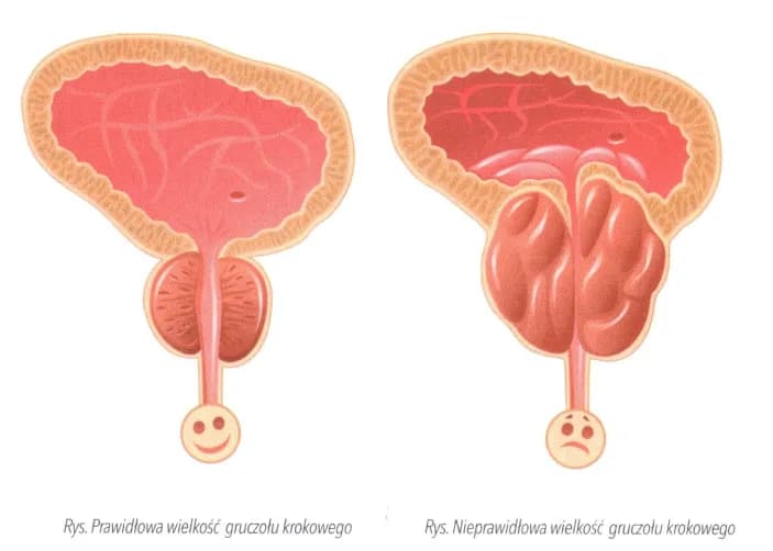 Objawy raka prostaty u mężczyzn - nie bagatelizuj tych sygnałów Objawy raka prostaty u mężczyzn - nie bagatelizuj tych sygnałów