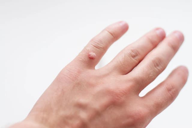 Czy można zarazić się kurzajką? Poznaj prawdę o infekcji HPV Czy można zarazić się kurzajką? Poznaj prawdę o infekcji HPV