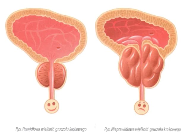 Jakie są objawy nowotworu prostaty? Ważne sygnały, których nie można zignorować Jakie są objawy nowotworu prostaty? Ważne sygnały, których nie można zignorować