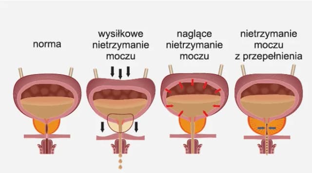 Nietrzymanie moczu u mężczyzn: przyczyny, objawy i skuteczne leczenie Nietrzymanie moczu u mężczyzn: przyczyny, objawy i skuteczne leczenie