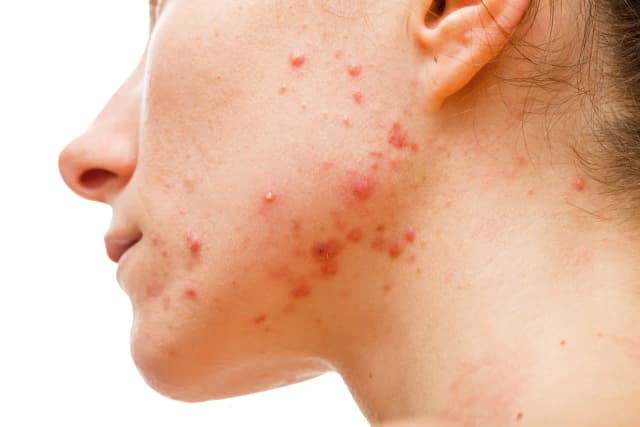 Zaburzenia hormonalne a objawy skórne: jak rozpoznać i leczyć problemy skóry Zaburzenia hormonalne a objawy skórne: jak rozpoznać i leczyć problemy skóry