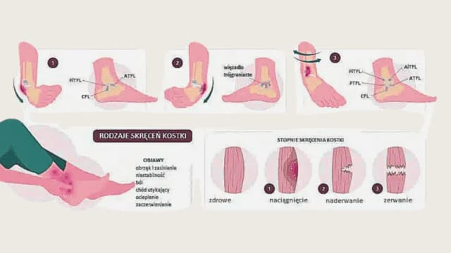 Skręcona kostka: Objawy, które musisz znać - Poradnik pacjenta Skręcona kostka: Objawy, które musisz znać - Poradnik pacjenta