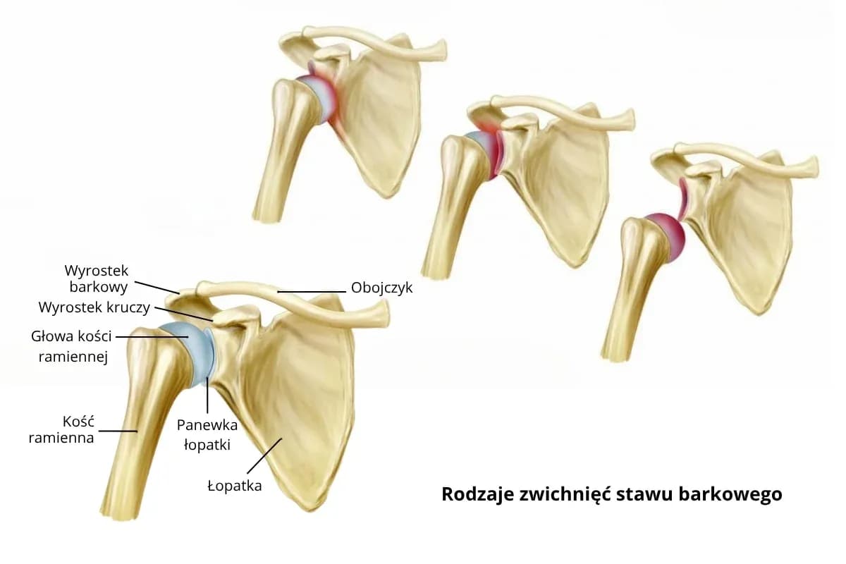 Wybity bark: skuteczne metody leczenia i rehabilitacji Wybity bark: skuteczne metody leczenia i rehabilitacji