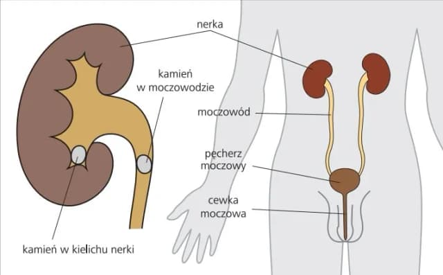 Czy alkohol przy kamicy nerkowej? Poznaj fakty i zagrożenia Czy alkohol przy kamicy nerkowej? Poznaj fakty i zagrożenia